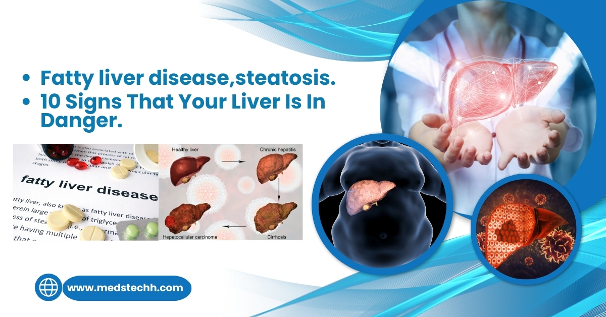 Tips to Diagnose Fatty Liver Diseases